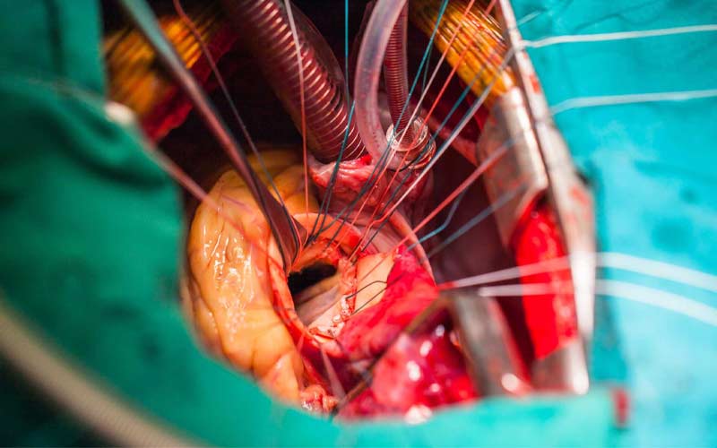 عمل گشادی دریچه قلب ممکن است به صورت جراحی باز یا بسته انجام شود. در این جراحی باید دریچه ترمیم یا تعویض شود.