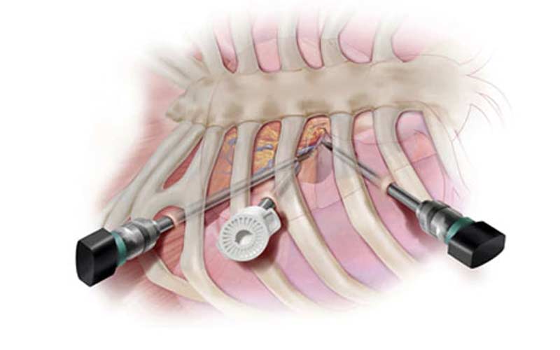 در طول جراحی بسته قلب، پزشک از فضای میان دنده‌ها به قلب دسترسی پیدا می‌کند.