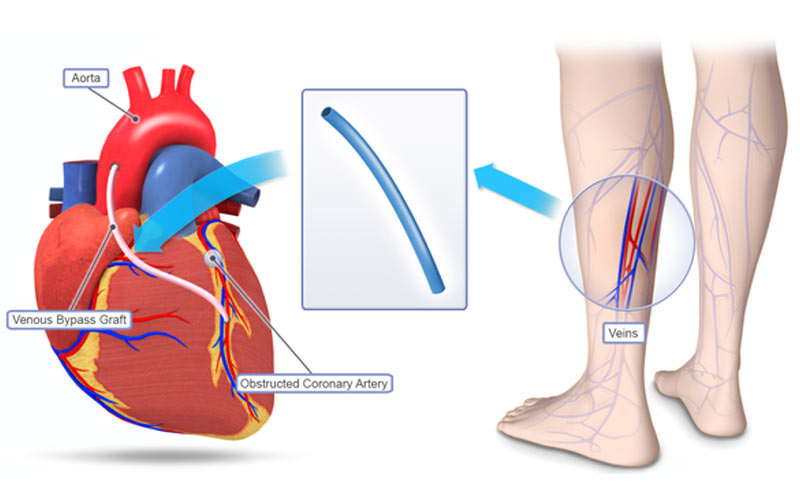 در جراحی بای پس قلب معمولا بخشی از رگ ساق پا برداشته می‌شود. 