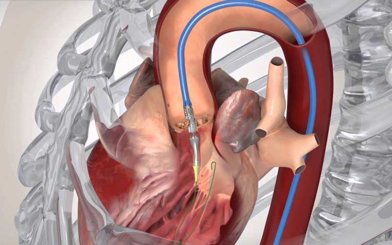 در طول جراحی لوله کاتتر از طریق کشاله ران به دریچه آئورت قلب می‌رسد و آن را باز می‌کند.