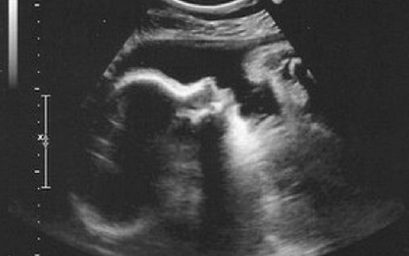 در این تصویر می‌توانید سونوگرافی هفته چهلم بارداری را مشاهده کنید.
