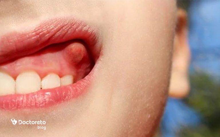 آبسه دندان، همه آنچه باید برای درمان و پیشگیری بدانید