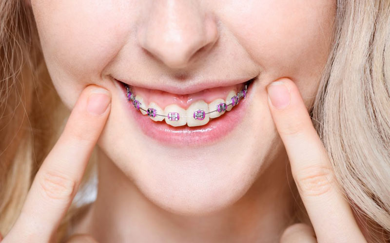 برای تراز کردن دندان‌ها از ارتودنسی سنتی استفاده می‌شود.