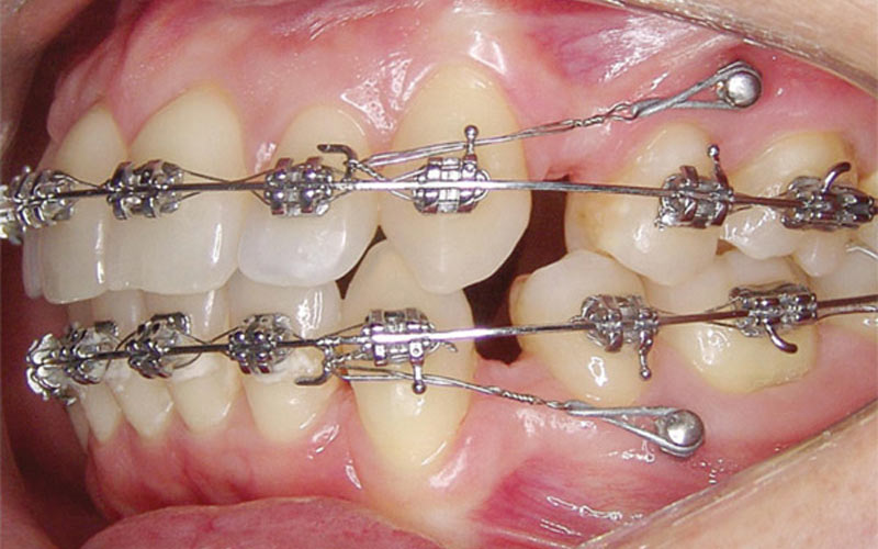 در این روش، مینی ایمپلنت در استخوان فک قرار گرفته و تکیه‌گاه دندان می‌شود.