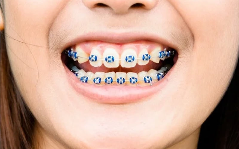 با این روش دندان‌ها هم تراز شده و مشکلات پیچیده دندان‌ها رفع می‌شود.