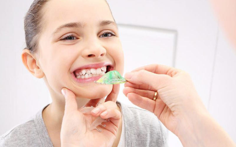 در فاز دوم ارتودنسی از بریس‌های سنتی ثابت و متحرک برای ترازشدن دندان‌ها استفاده می‌شود.