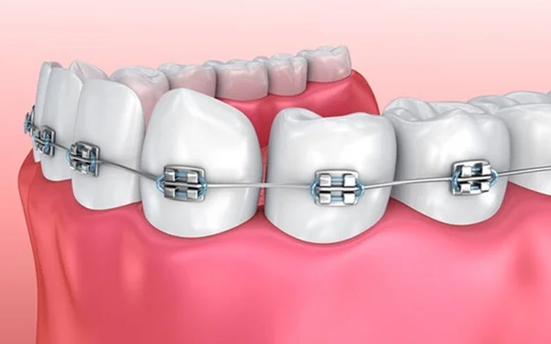  براکت‌های فلزی روی دندان‌ها چسبیده شده و سیم فلزی آنها را به هم وصل می‌کند.