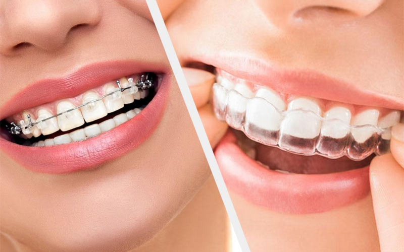 تمیز کردن بریسهای ثابت نسبت به متحرک سختتر است و باید نحوه رعایت بهداشت را یاد گرفت.