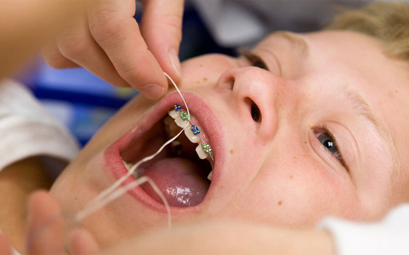 برای جلوگیری از عوارض ارتودنسی باید هر روز به‌طور منظم از نخ دندان و مسواک استفاده شود.