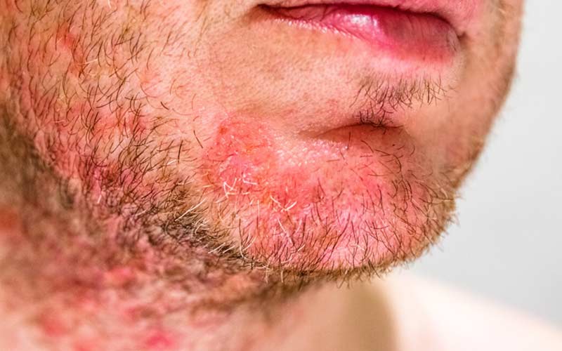 فولیکولیت می‌تواند باعث قرمزی و حساس شدن پوست شود. 