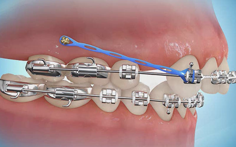برای اصلاح بیرون‌زدگی دندان‌های جلویی فک بالا می‌توان از ارتودنسی مینی اسکرو استفاده کرد.