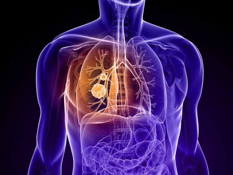 متداول‌ترین نشانه سیستیک فیبروزیس، آسیب پیش‌رونده سیستم تنفسی و مشکلات مزمن دستگاه گوارش است.