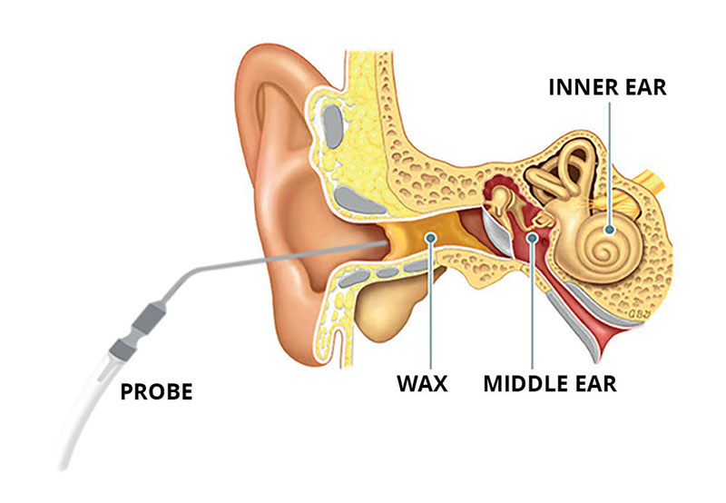 تجمع و افزایش جرم گوش یکی از شایع‌ترین دلایل گرفتگی گوش است که پزشکان با آن مواجه می‌شوند.