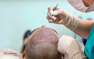 کاشت مو به روش fue: مزایا، عوارض و روش انجام آن