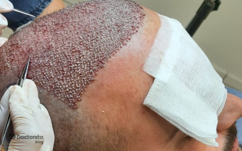 عوارض و خطرات کاشت مو به روش fue