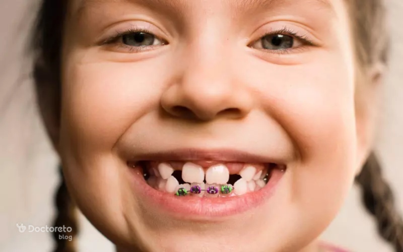 ارتودنسی دو فاز، راهی برای اصلاح مشکلات دندان کودکان