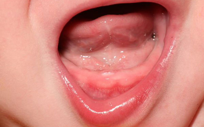 بردن کودک نزد دندانپزشک اطفال می‌تواند نقش مهمی در پیشگیری از التهاب لثه داشته باشد.