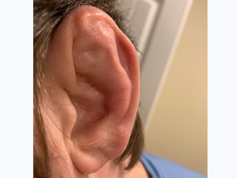 از عوامل خطر گوش گل کلمی از دست دادن شنوایی است.