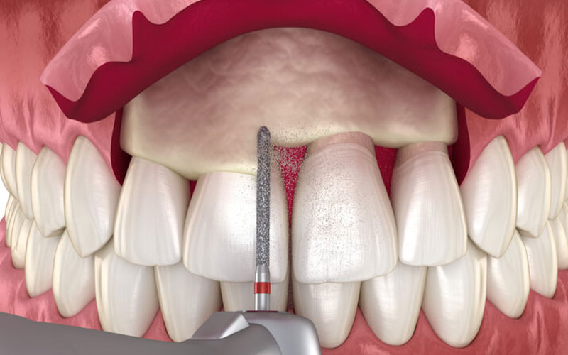  از روش ژنژیوکتومی برای برداشتن بافت اضافی و بازسازی خط لثه و جلوگیری از جمع شدن پلاک دندان استفاده می‌شود.