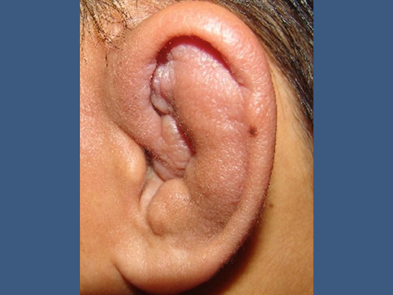 هماتوم لاله گوش چیست و چه علائمی دارد؟