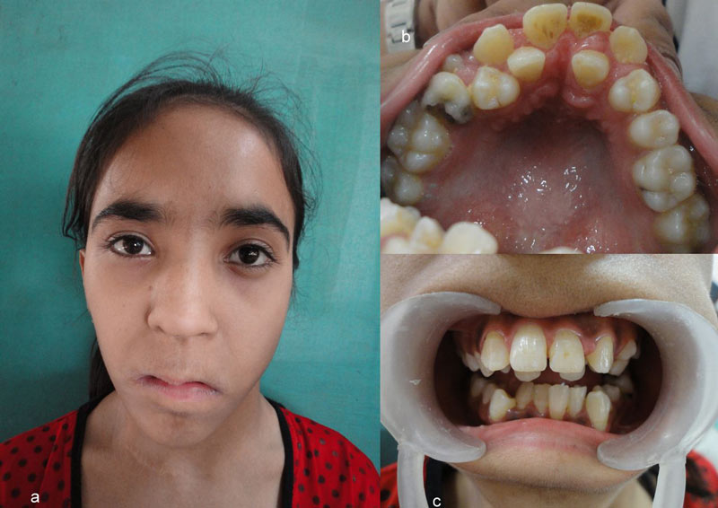 در این بیماران وضعیت دندان‌ها هم دچار مشکل شده و مشکلات ارتودنسی ایجاد می‌شود.