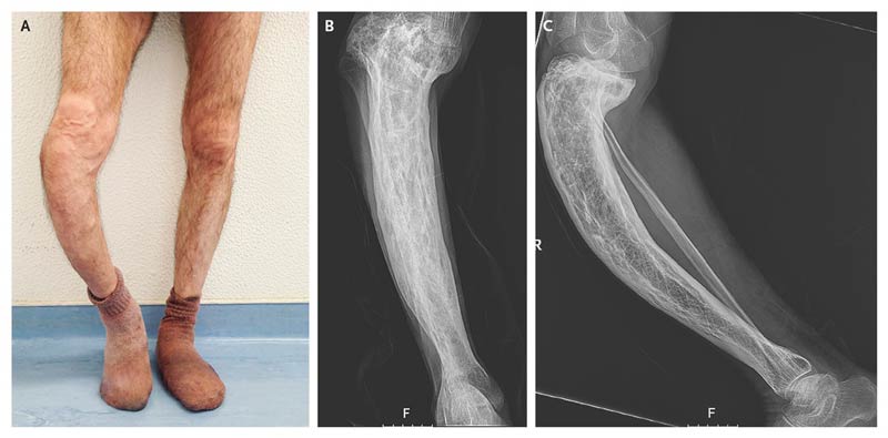 رشد غیرطبیعی استخوان در بیماری پاژه ممکن است باعث بدشکلی پاها شود.