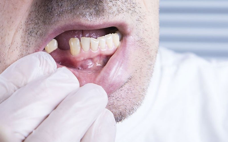 تحلیل لثه زمانی اتفاق می‌افتد که بافت لثه از سطح دندان پسروی کند. 