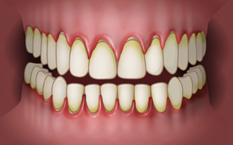 پلاک دندان مانند چسب به اطراف و زیرخط لثه دندانی می‌چسبد 
