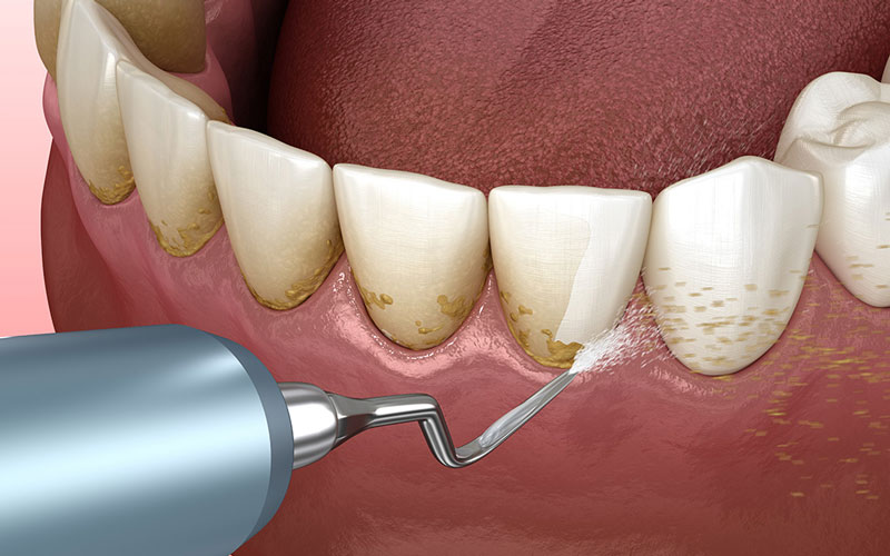 بیماری تحلیل لثه باعث از دست دادن دندان در حدود 70 درصد از بزرگ‌سالان می‌شود. 