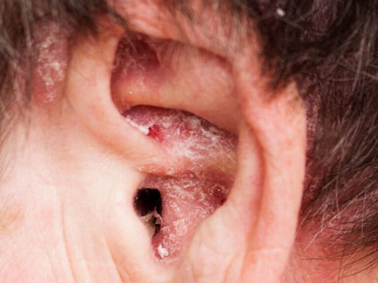 اگزمای لاله گوش چه علائمی دارد؟ چگونه می توان آن را درمان کرد؟