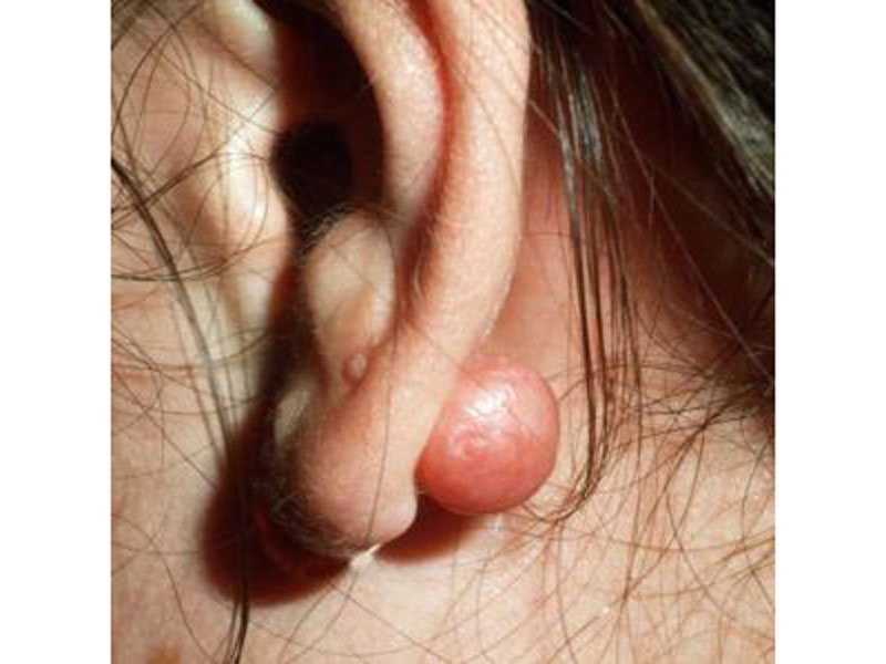 چه کسانی به کلوئید گوش مبتلا می‌شوند؟