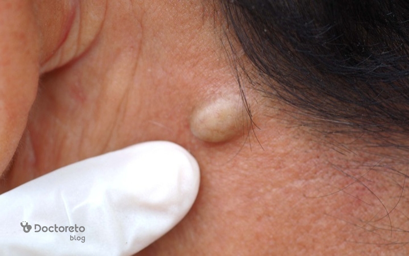 شکل ظاهری و ساختار کیست لاله گوش چگونه است؟