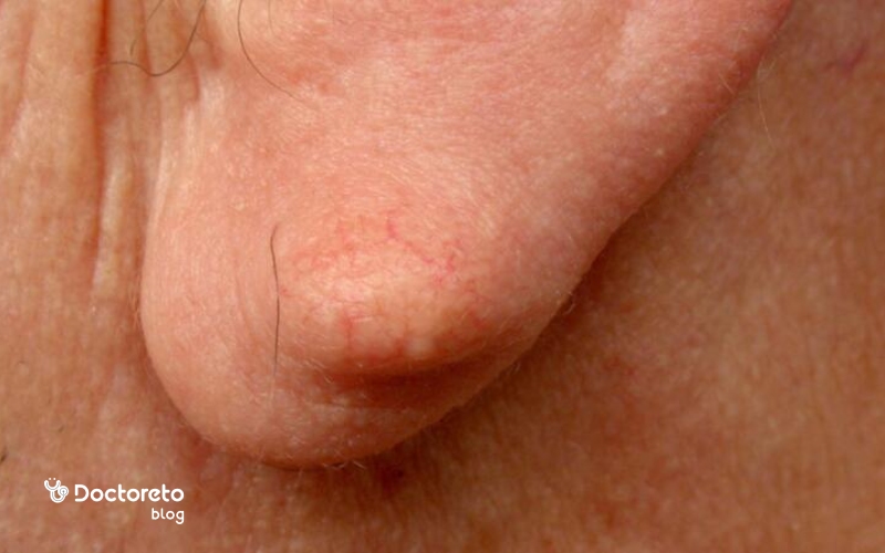 تشخیص کیست لاله گوش