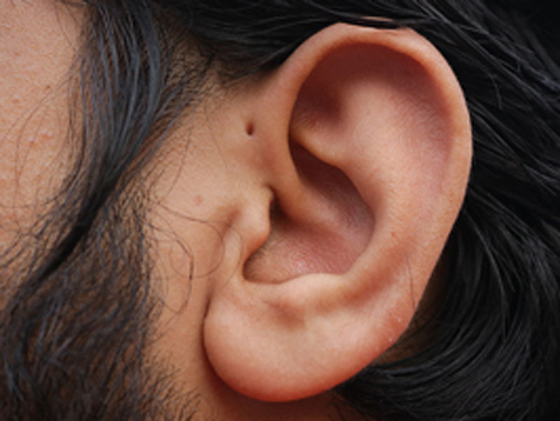 معمولاً سینوزیت گوش یک حفره در سمت راست است اما امکان دارد که برخی نوزادان با دو حفره متولد شوند.