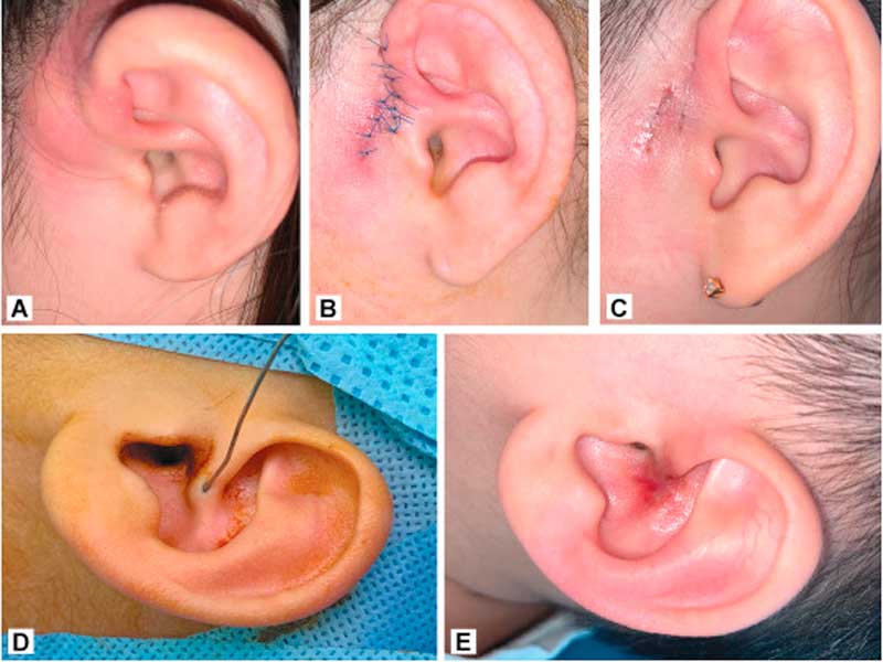 اگر به آبسه گوش مبتلا شدید، در این حالت دکتر شما سوزن نازکی را برای جمع‌آوری مایع داخل حفره گوش در آن وارد می‌کند.
