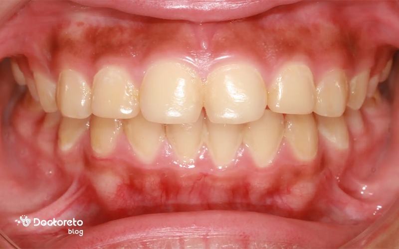 عکس تحلیل لثه کودک