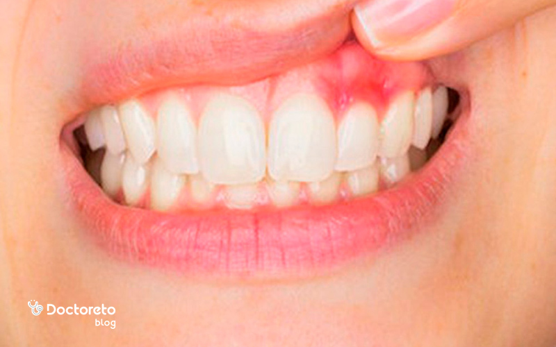 علت بروز بیماری تحلیل لثه در کودکان چیست؟