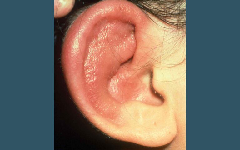 پریکندریت گوش چیست و چه علائمی دارد؟