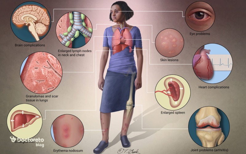 بیماری سارکوئیدوز چه اندام هایی را درگیر می کند؟