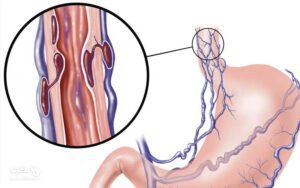 بیماری واریس مری چیست و چگونه درمان می شود؟