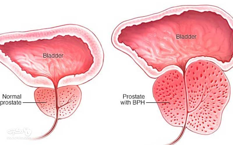 بزرگ شدن غده پروستات باعث باریک شدن مجرای ادرار و فشار بر پایه مثانه می‌شود.