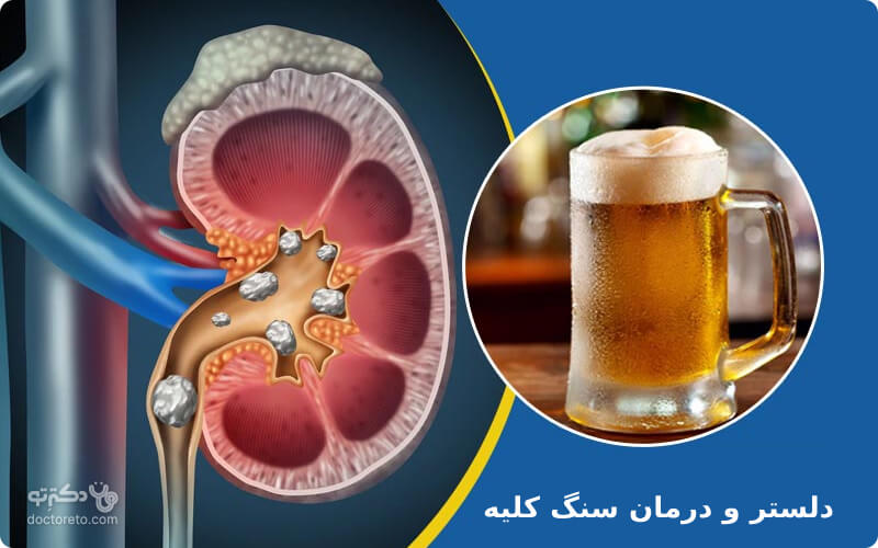 دلستر تلخ و آبجو تاثیر بسزایی در دفع سنگ کلیه دارد
