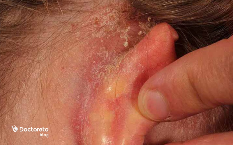 عوارض اگزمای لاله گوش