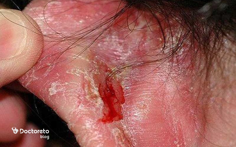 علل ابتلا به اگزمای لاله گوش