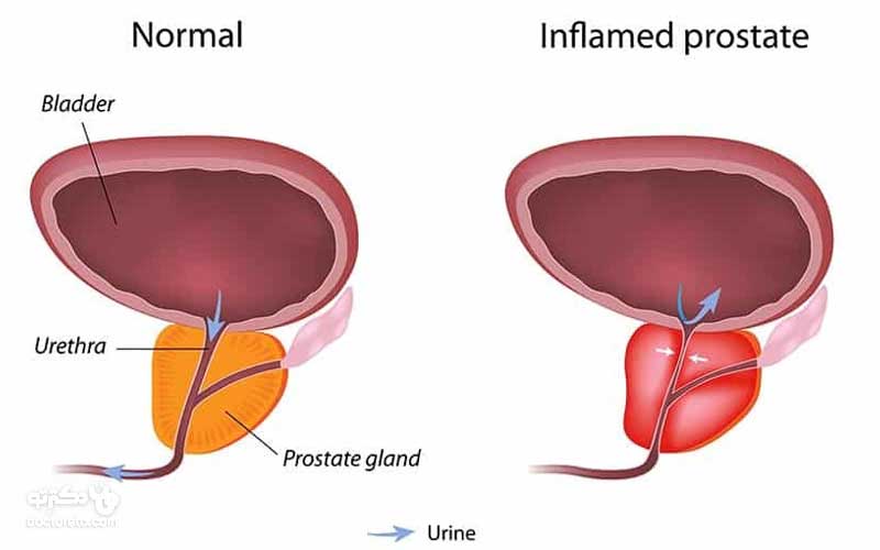پروستاتیت یا التهاب پروستات چیست و چه علائمی دارد؟