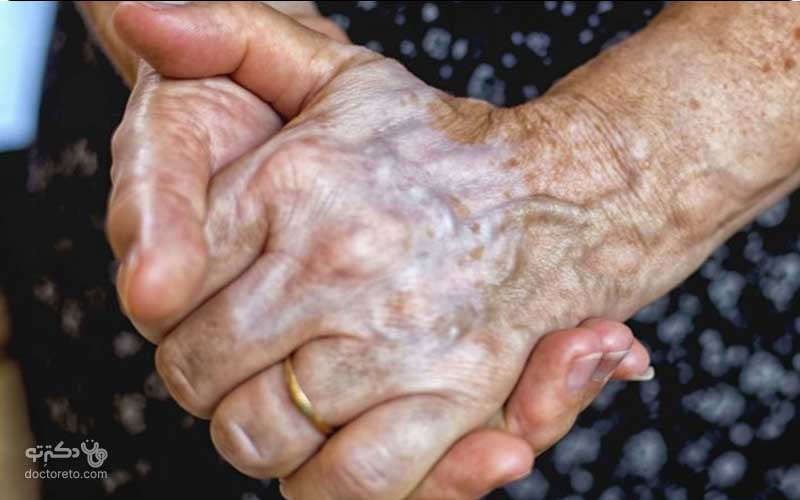 برآمدگی روی دست می‌تواند دلایل مختلفی از جمله بیماری‌های زمینه‌ای داشته باشد.