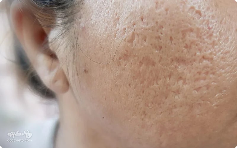 جای جوش روی پوست صورت ممکن است به شکل یک نقطه سرخ یا سفید در سطح پوست دیده شود.