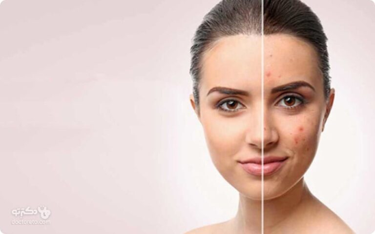 راه از بین بردن جای جوش چیست؟