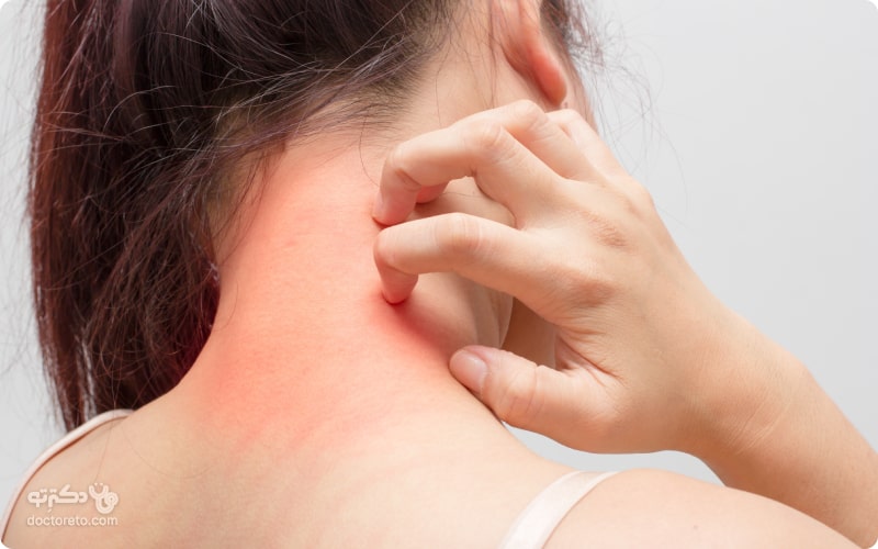 مهمترنی علائم حساسیت پوستی شامل قرمزی، تورم، کهیر و خارش است.