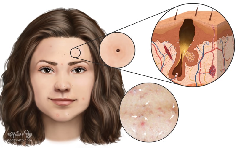 جوش سر سیاه در نواحی پوستی با ترشح چربی بالا رخ می‌دهد.